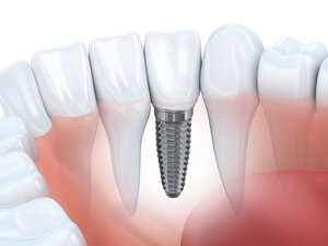 illustration of teeth in gums with dental implant Wallace, NC